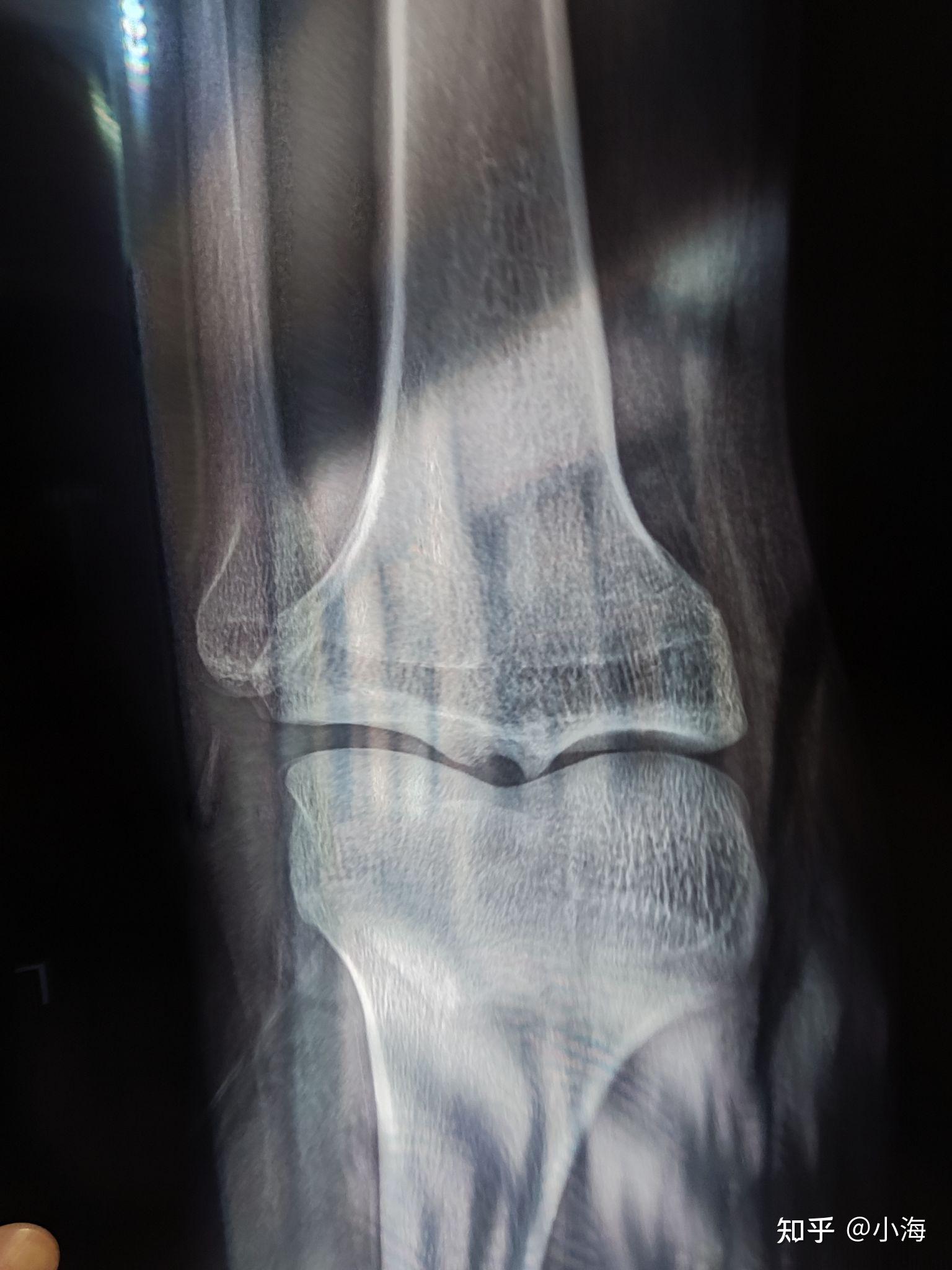 骨骺线接近闭合可以增高吗