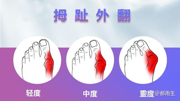郝雨生解说，缓解大脚骨疼痛方法? - 知乎