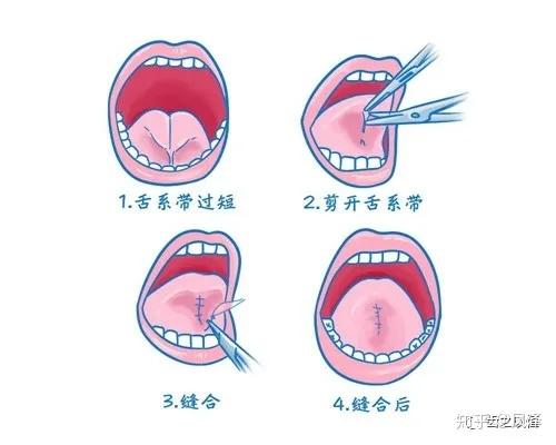 舌系带短压舌训练图解图片