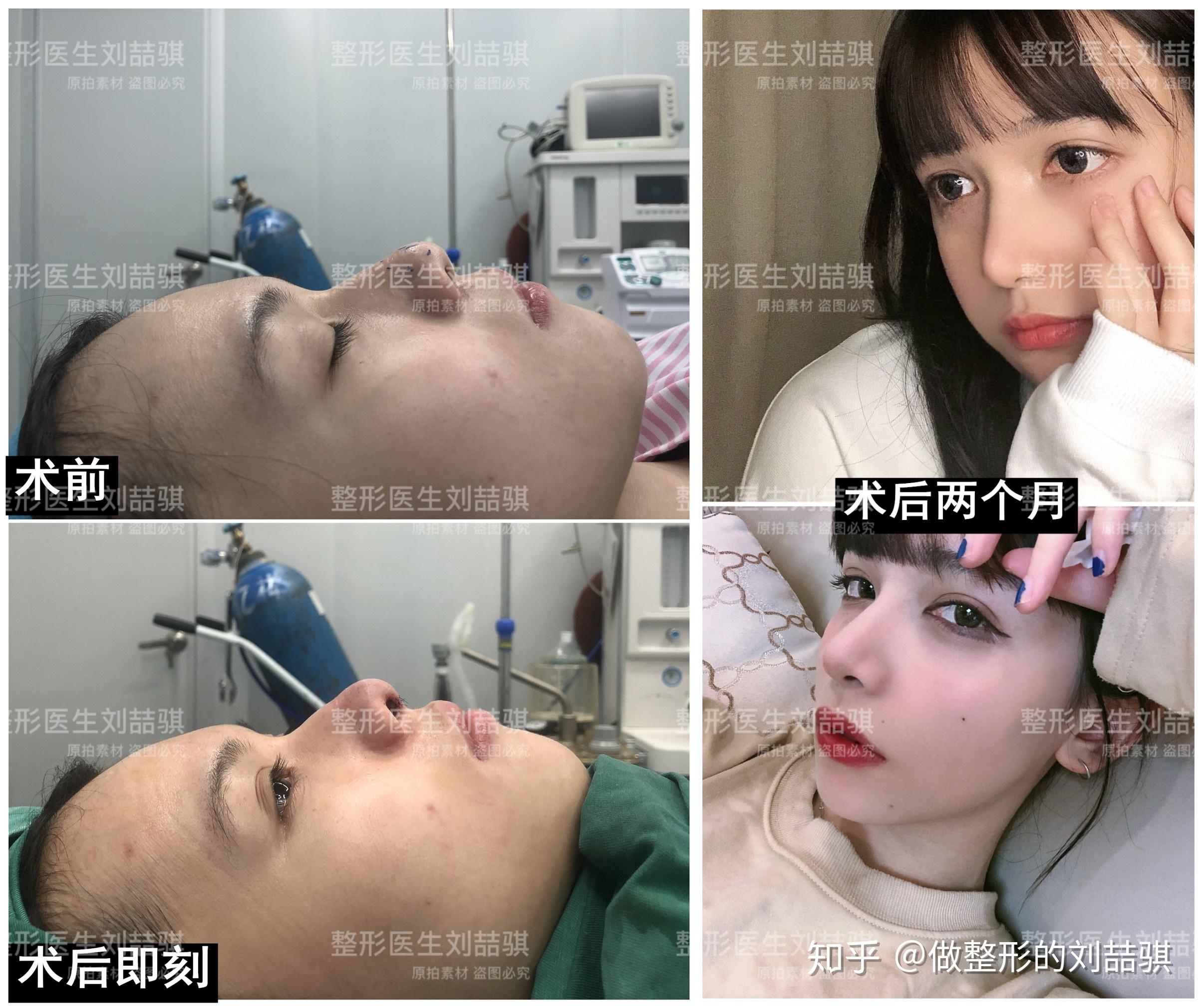 不放假体单独垫高鼻头结果怎么样