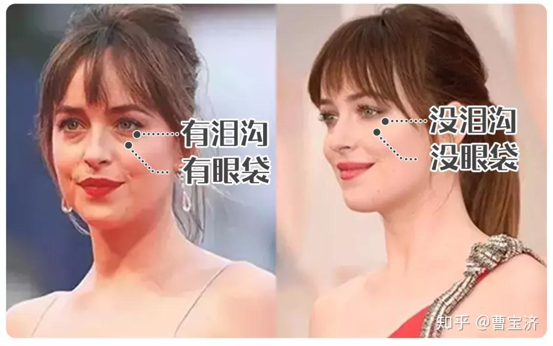 科普 | 泪沟类型分不清?难怪你的泪沟花了10年还去不掉 - 知乎