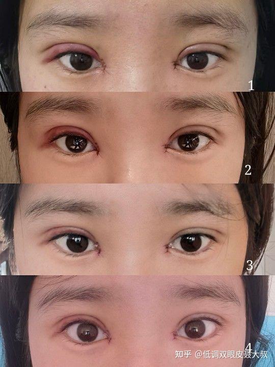 烟台双眼皮案例分享:小眼内双有必要做双眼皮吗? - 知乎