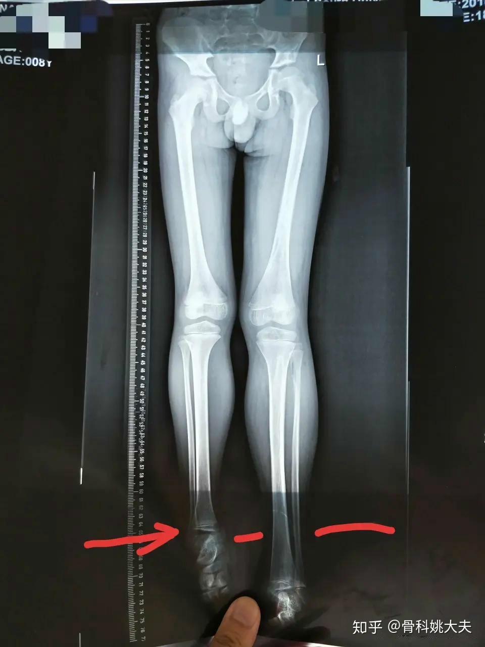 如不治疗,除了行走难看外,跟关键的是双侧不平衡会导致全身多关节的