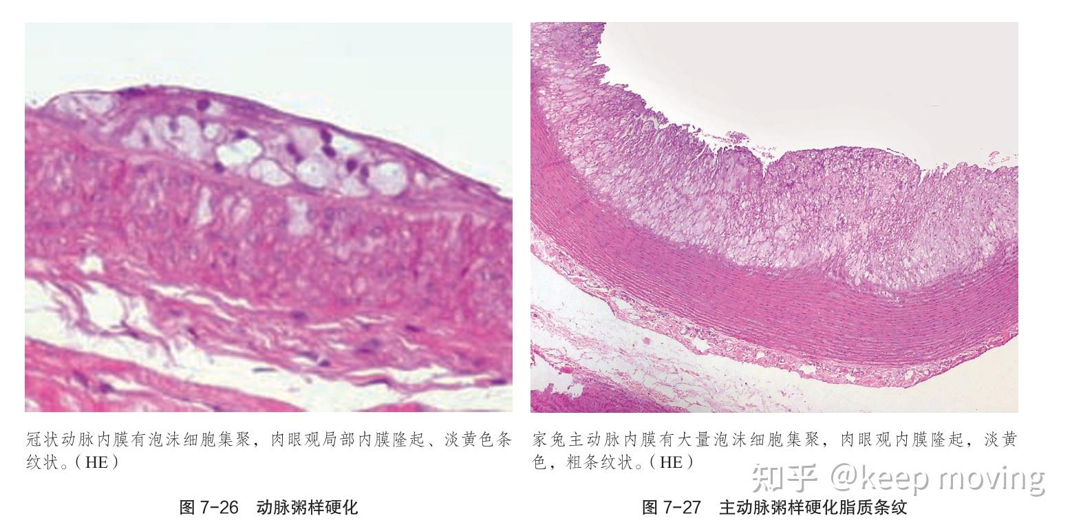 动脉粥样硬化病理变化及造模 - 知乎