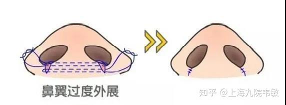 整形科普丨鼻翼缩小怎么缩究竟缩小了哪里