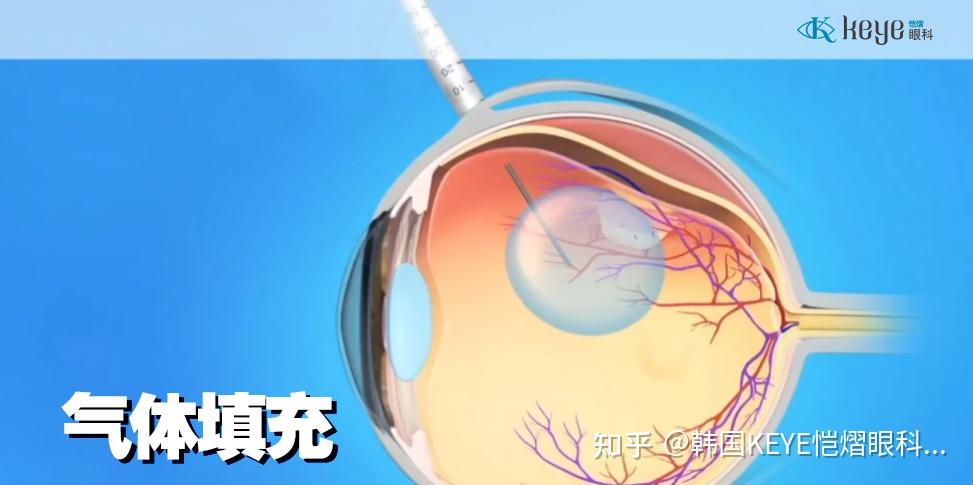 01气体填充因为这种膜可直接切除,借助玻璃体切割术,将探针插入眼内