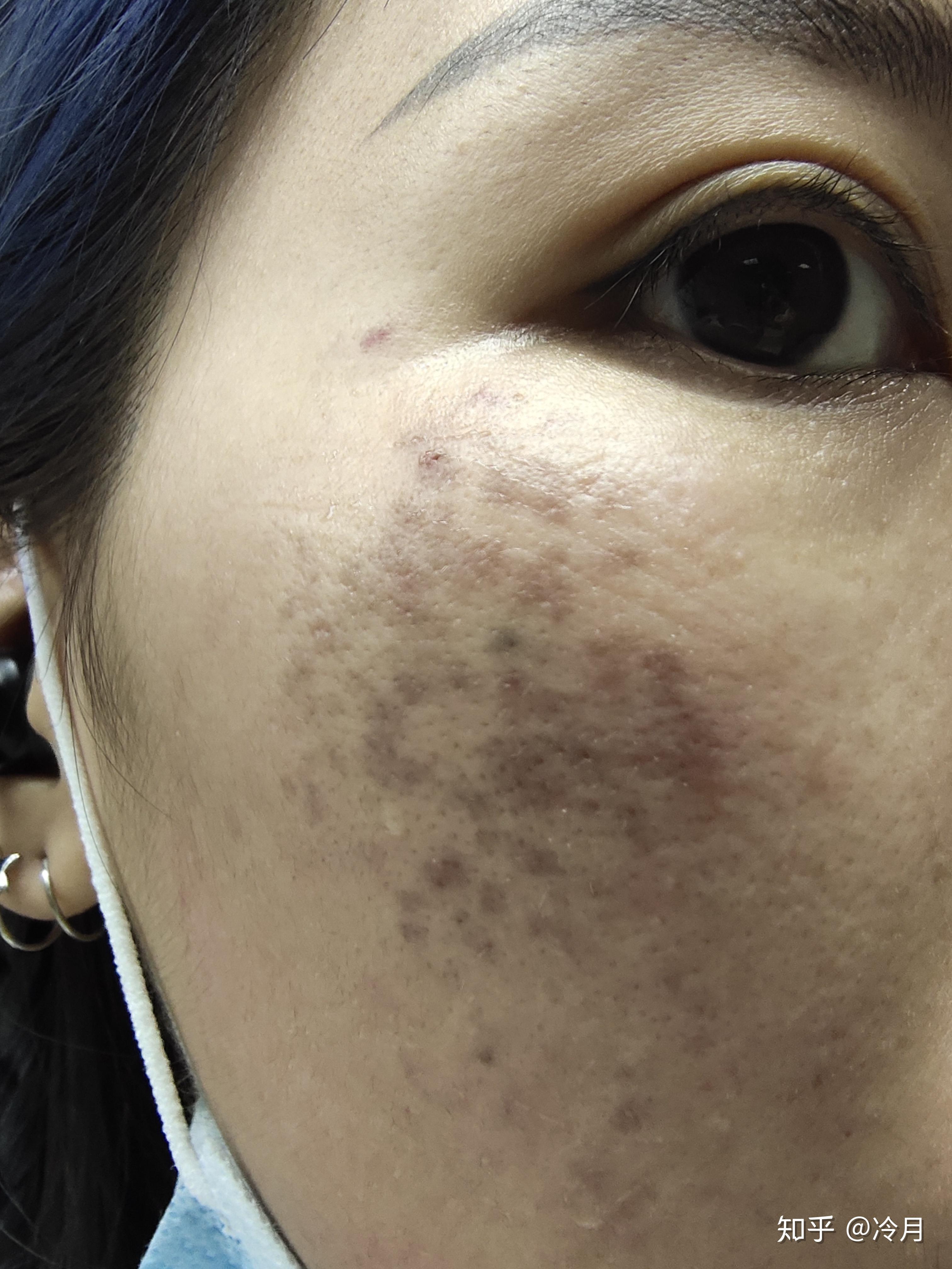 褐青色痣激光日志2