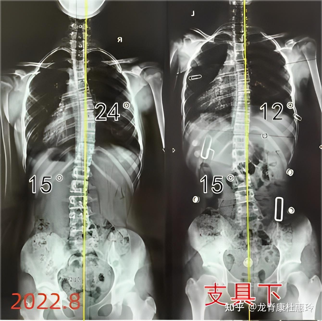 脊柱侧弯女孩,坚持治疗半年后减至14度,剃刀背回归正常范围! - 知乎