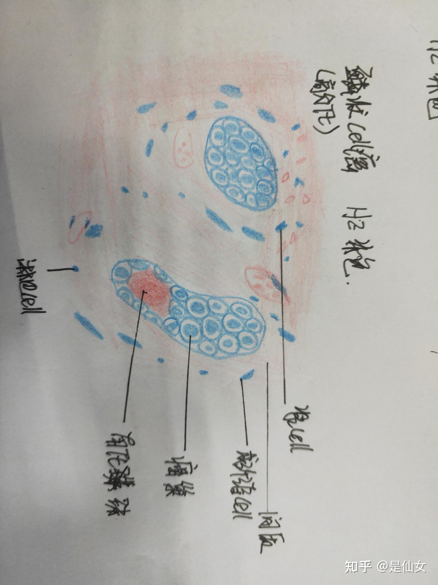 病理学红蓝铅笔绘画图实验课题平滑肌瘤与鳞状上皮细胞癌