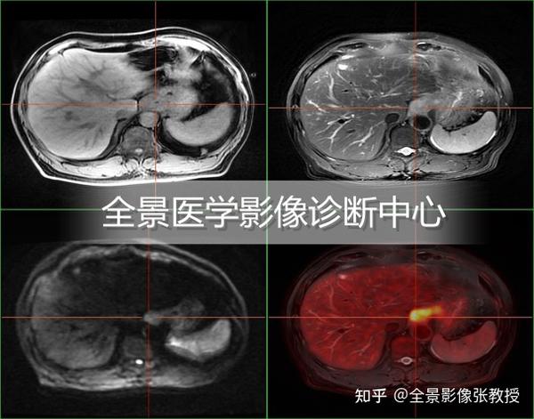 PET/MR在胃癌伴肝转移的案例分享 - 知乎