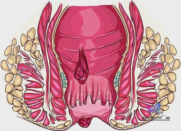 "十人九痔"竟与这一习惯有关!很多人每天都做却毫不知情