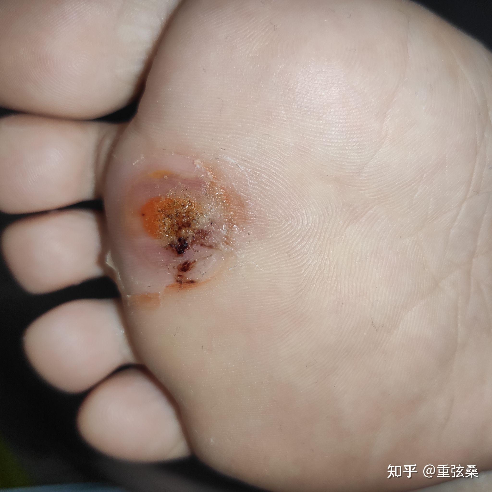 脚底跖疣激光冷冻治疗过程更新中