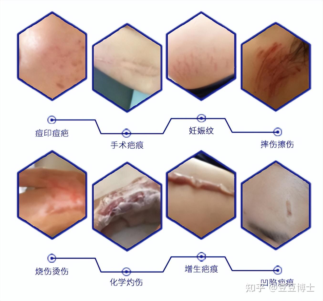 疤痕愈合过程图图片