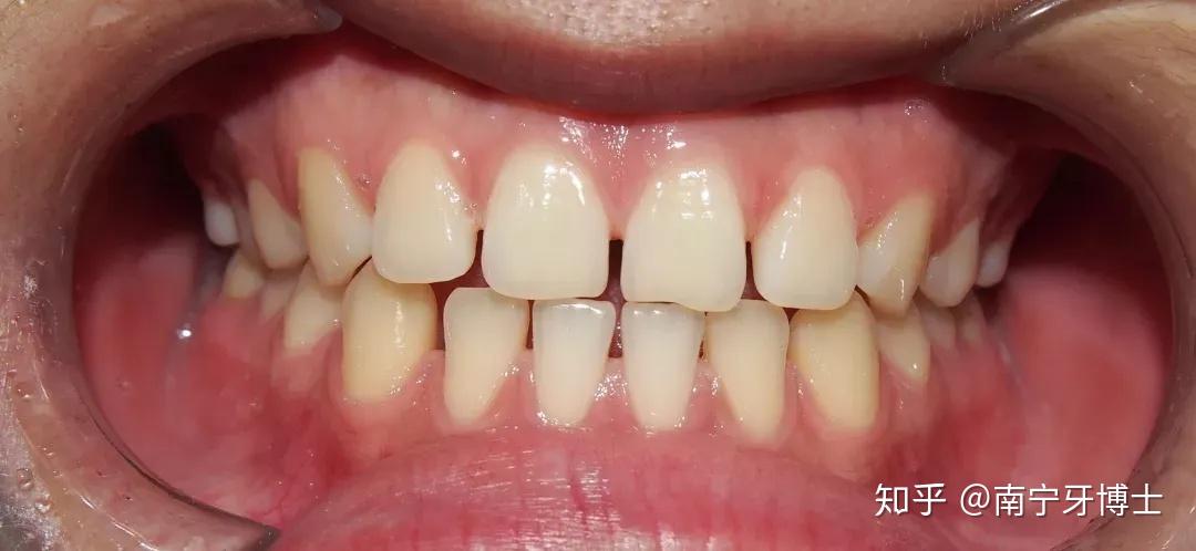 我的5mm 大牙缝 就是这样合拢的! - 知乎