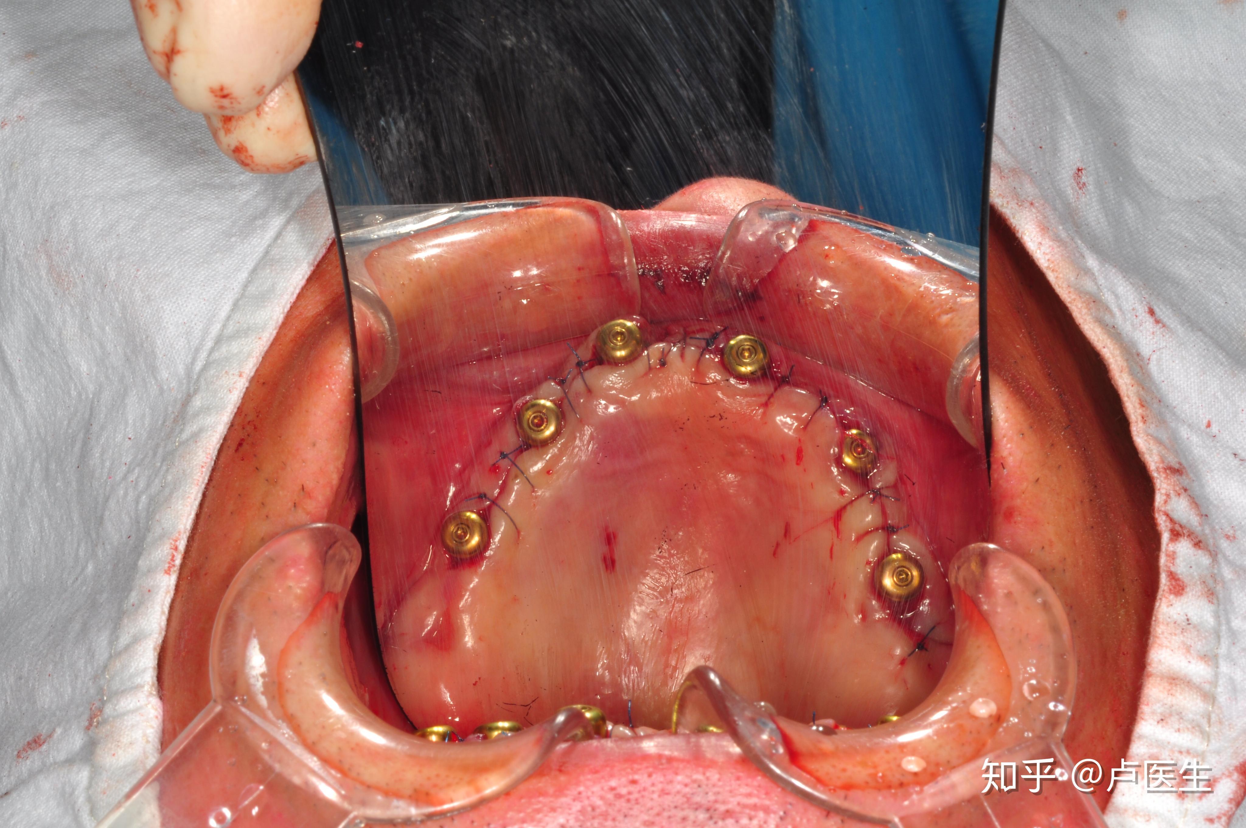 什么是allon4全口种植牙技术