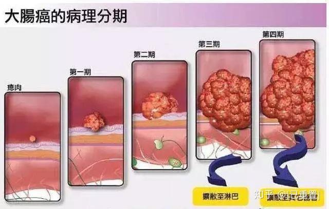 大腸癌號稱癌老二從腸道功能讀懂癌信號