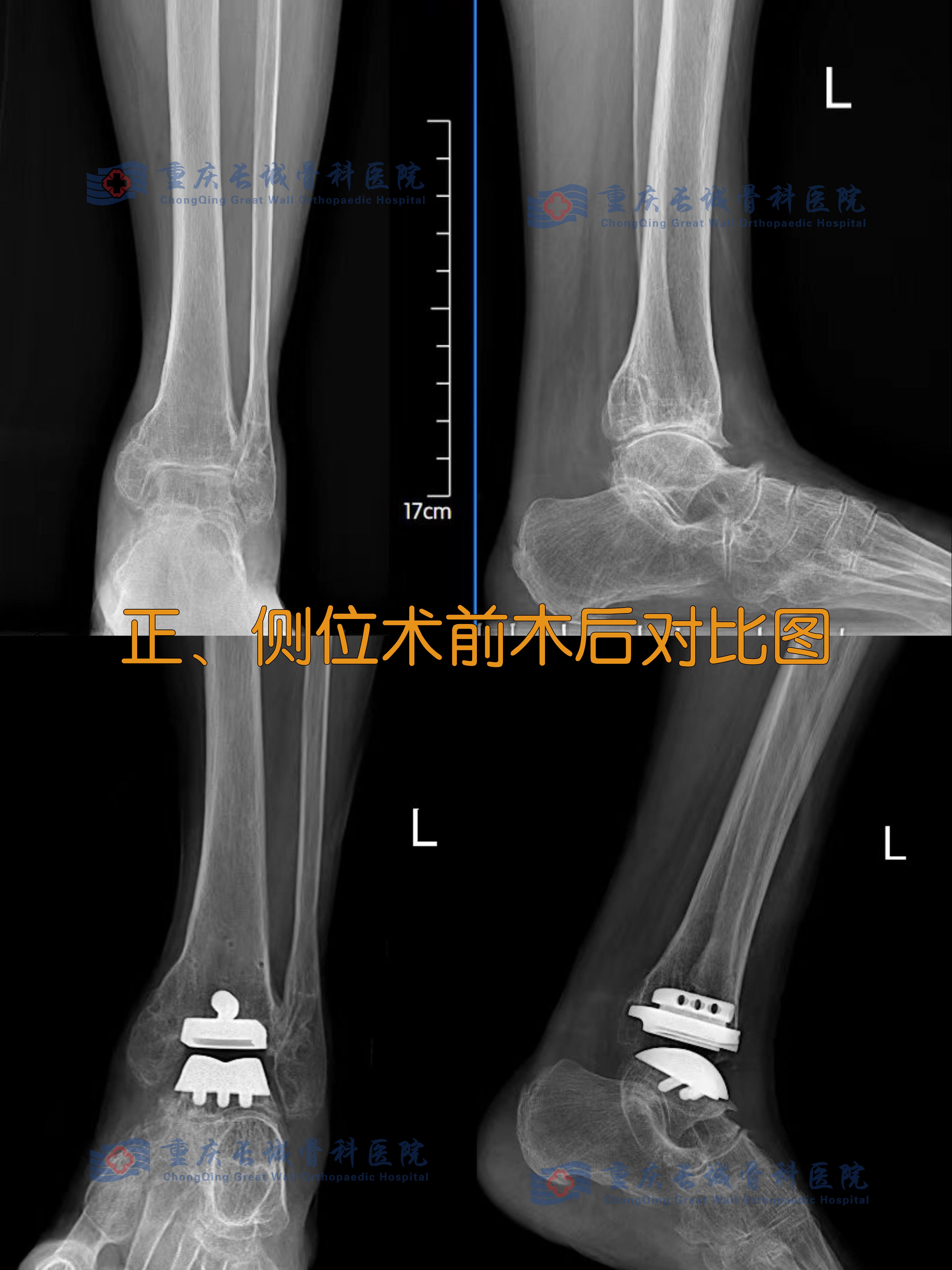 七年疼痛一朝除 重庆长城骨科医院成功开展院内首例踝关节置换术