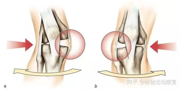 例如膝盖外侧被击中,导致膝盖向内侧弯曲,mcl就会被拉长扭伤甚至发生