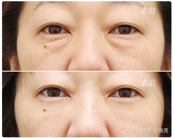 眼睛模糊看不清是怎么回事35岁 v2-a0907c054e22f84aab376e3e9e3cec96_r.jpg