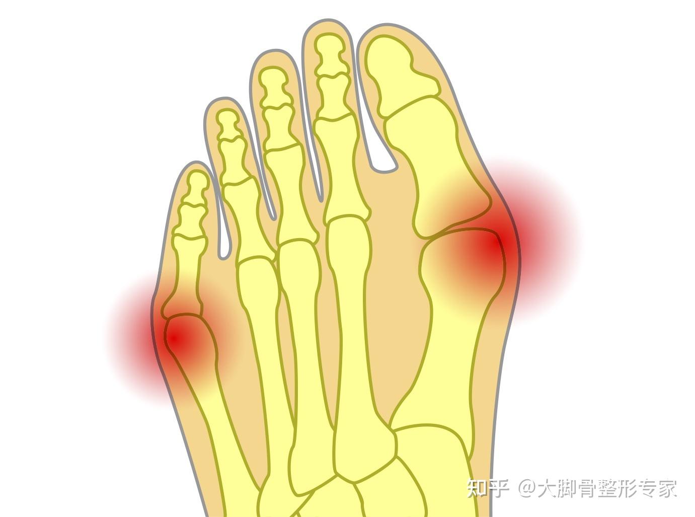 脚宽如这样的情况,前足较宽是由大脚骨和小脚骨导致的,那么可以通过