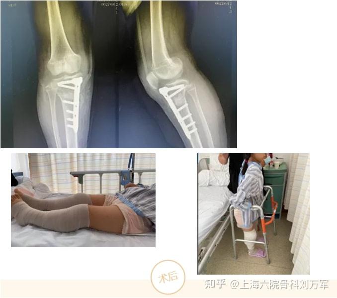 儿童骨骼先天发育不良o型腿严重胫骨高位截骨来拯救