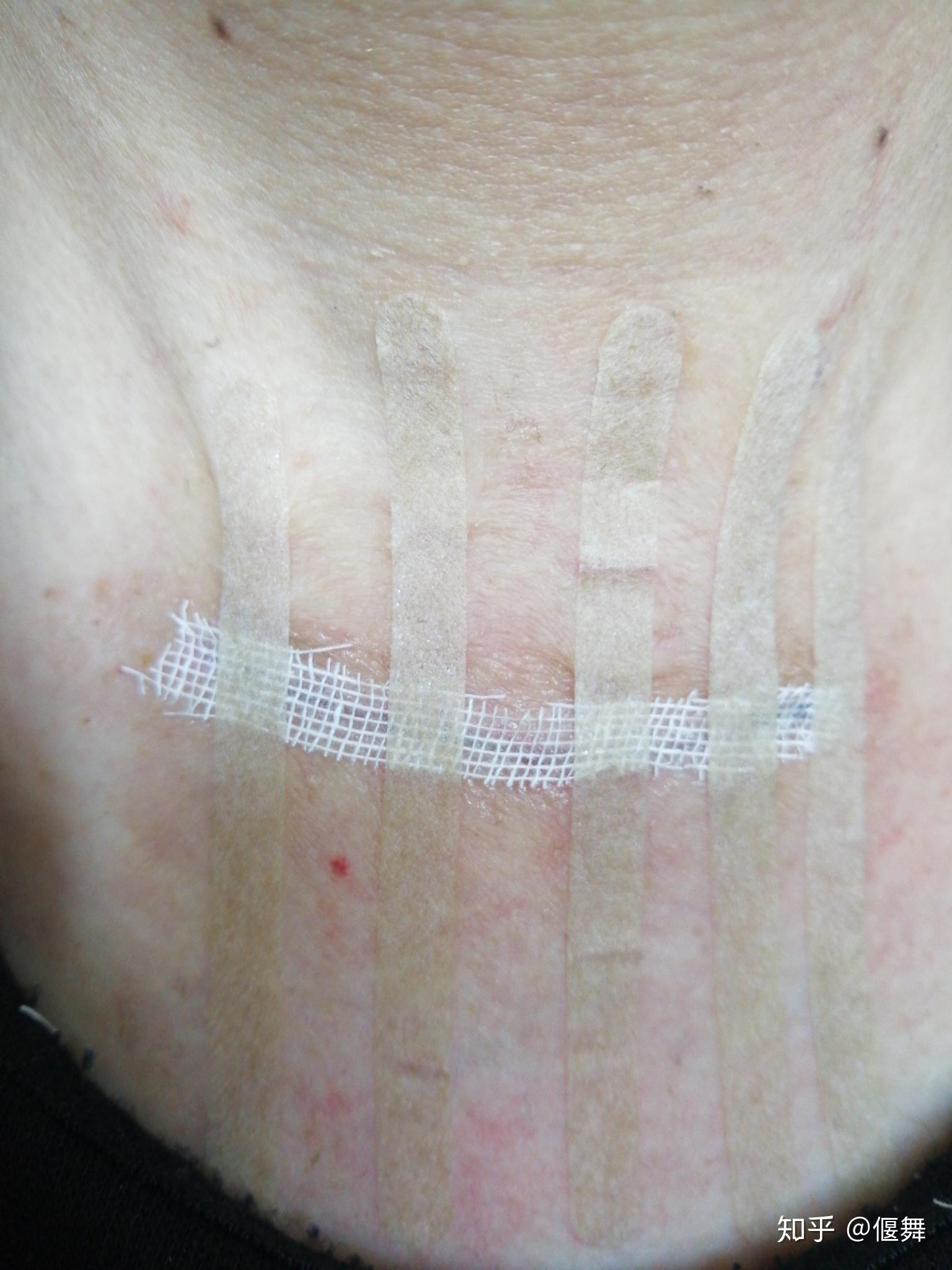 记录我的甲状腺手术伤口恢复历程 - 知乎