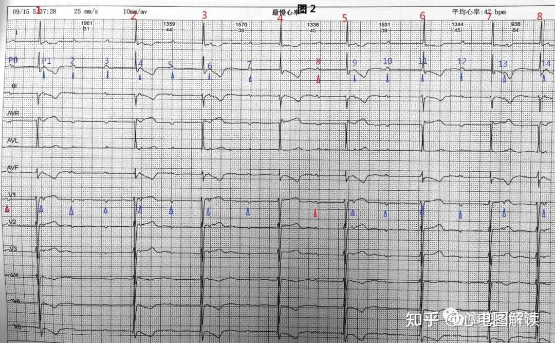 今天要分享的心電圖