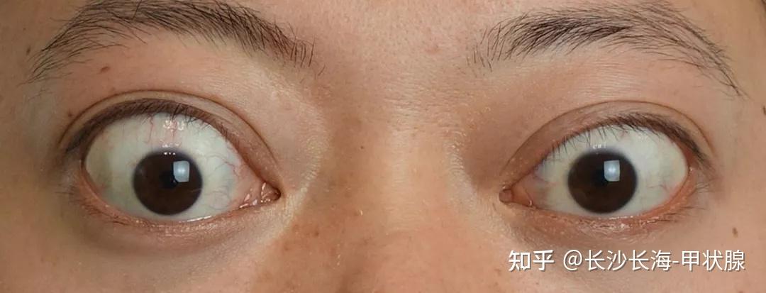 甲亢突眼也有等级之分你都知道吗
