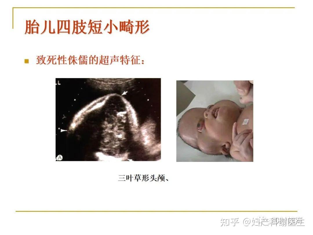 胎儿肢体畸形：超声图表现如何解读和诊断？早发现早处理！ - 知乎