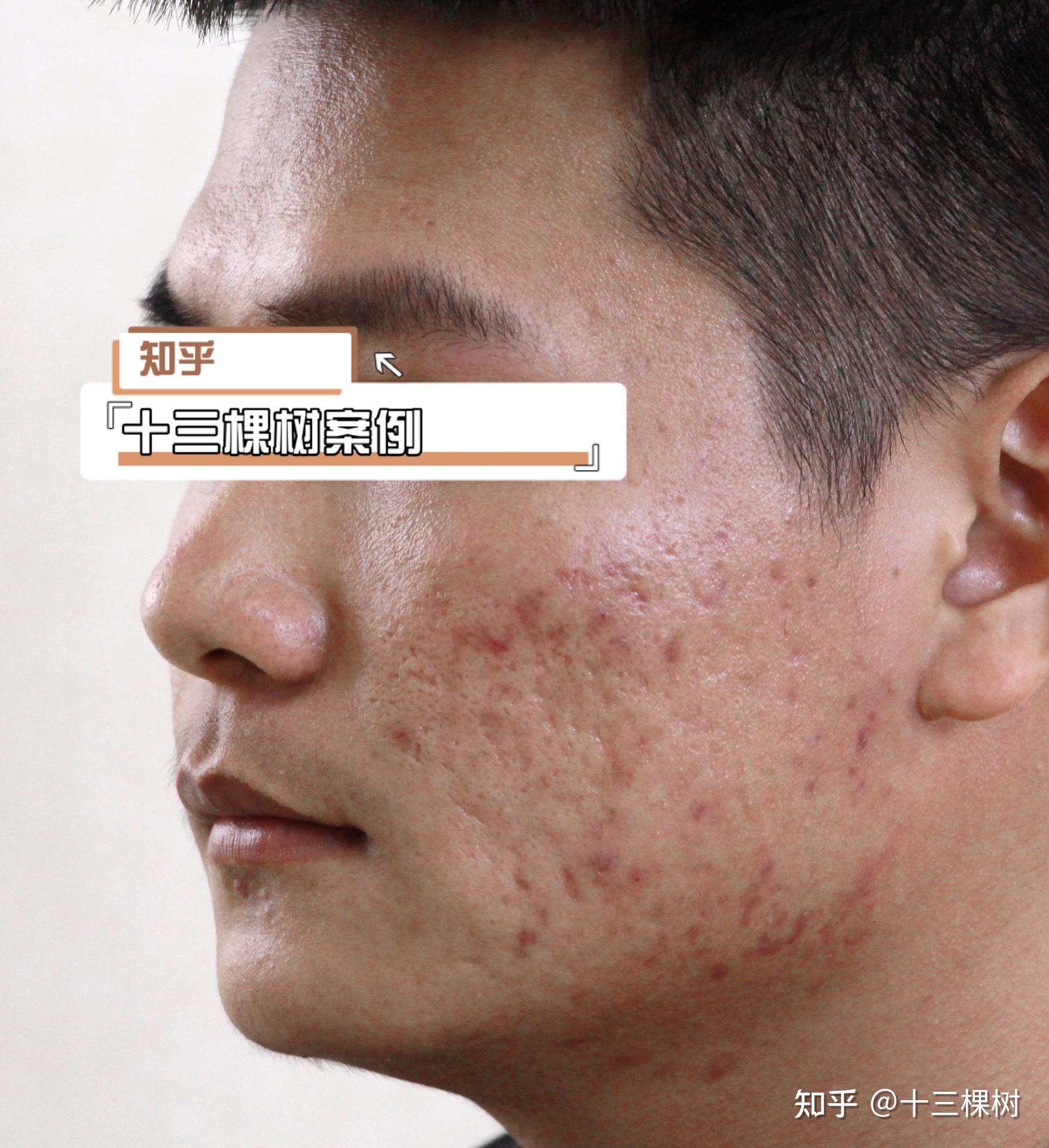两次痘坑治疗可能这就是恢复超人吧