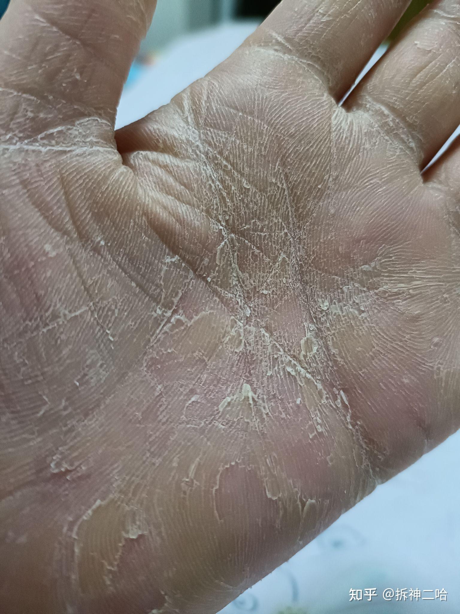 手脚遗传性脱皮发红 手掌较普通人更硬 应该怎样治疗? - 知乎