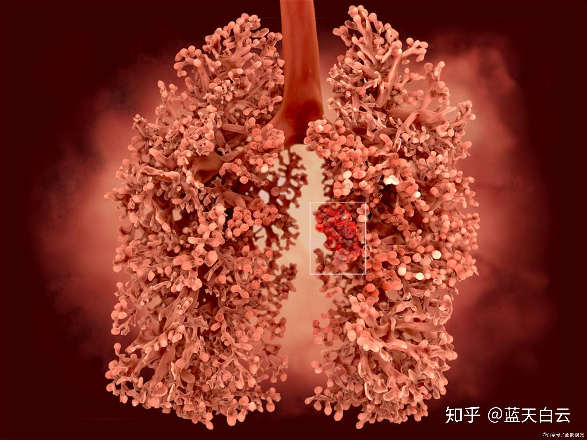 肺癌症状有哪些？是什么原因导致的呢？_患者_病因_支气管