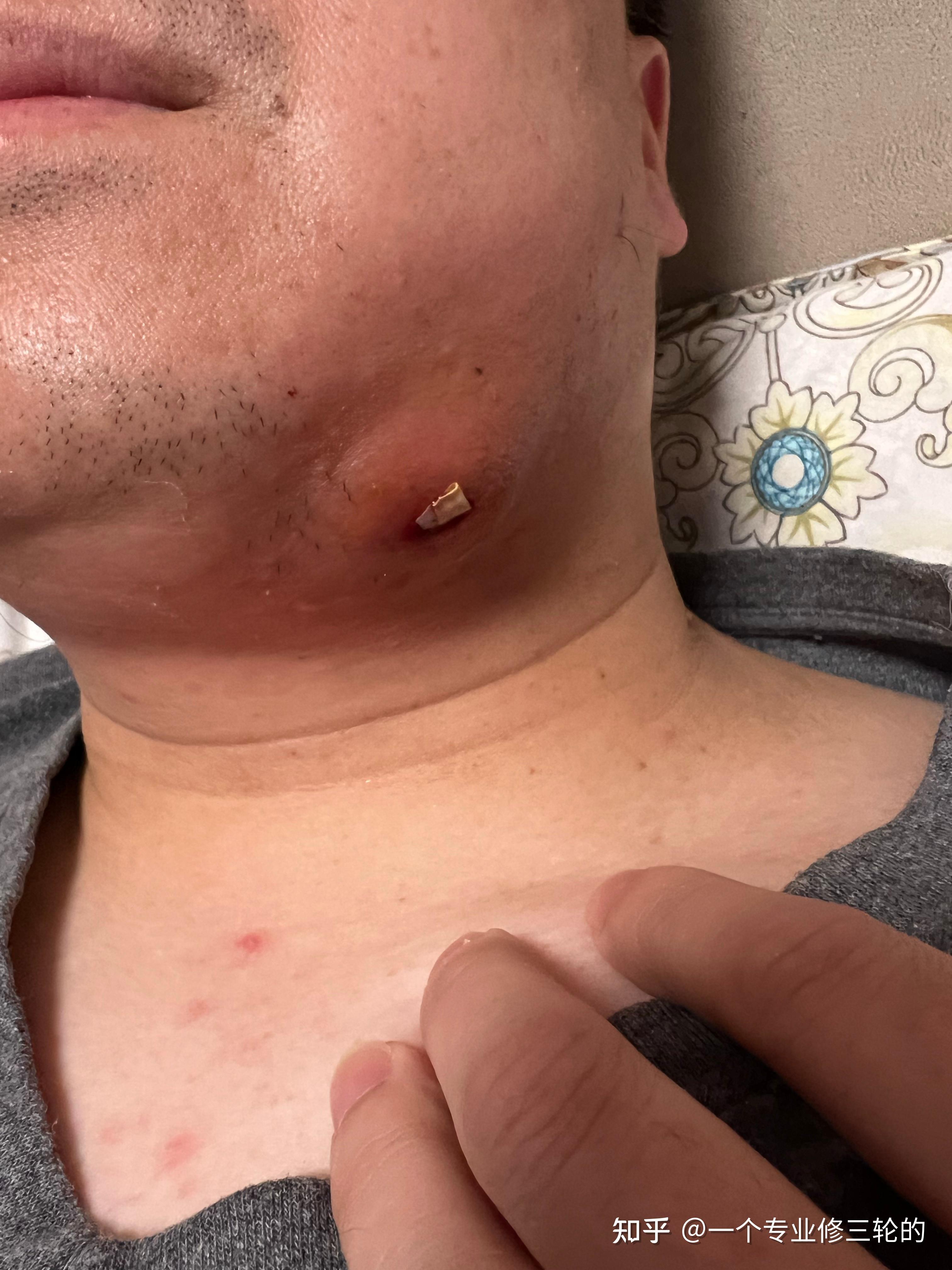 两个月,下颌间隙感染的治疗历程