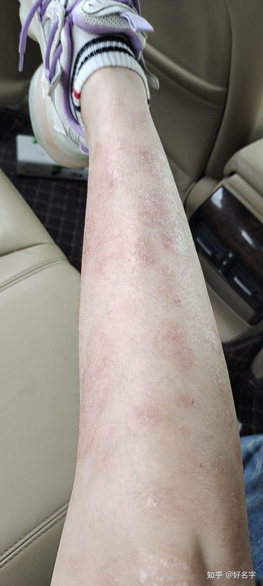 6.13银屑病 生物制剂可善挺日常记录 希望给病友一些参考吧