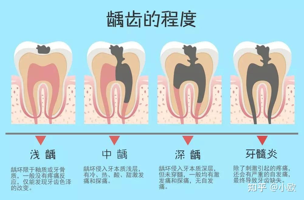 假如牙齿得了浅龋把浅表性龋坏的小黑点磨掉不补可以吗