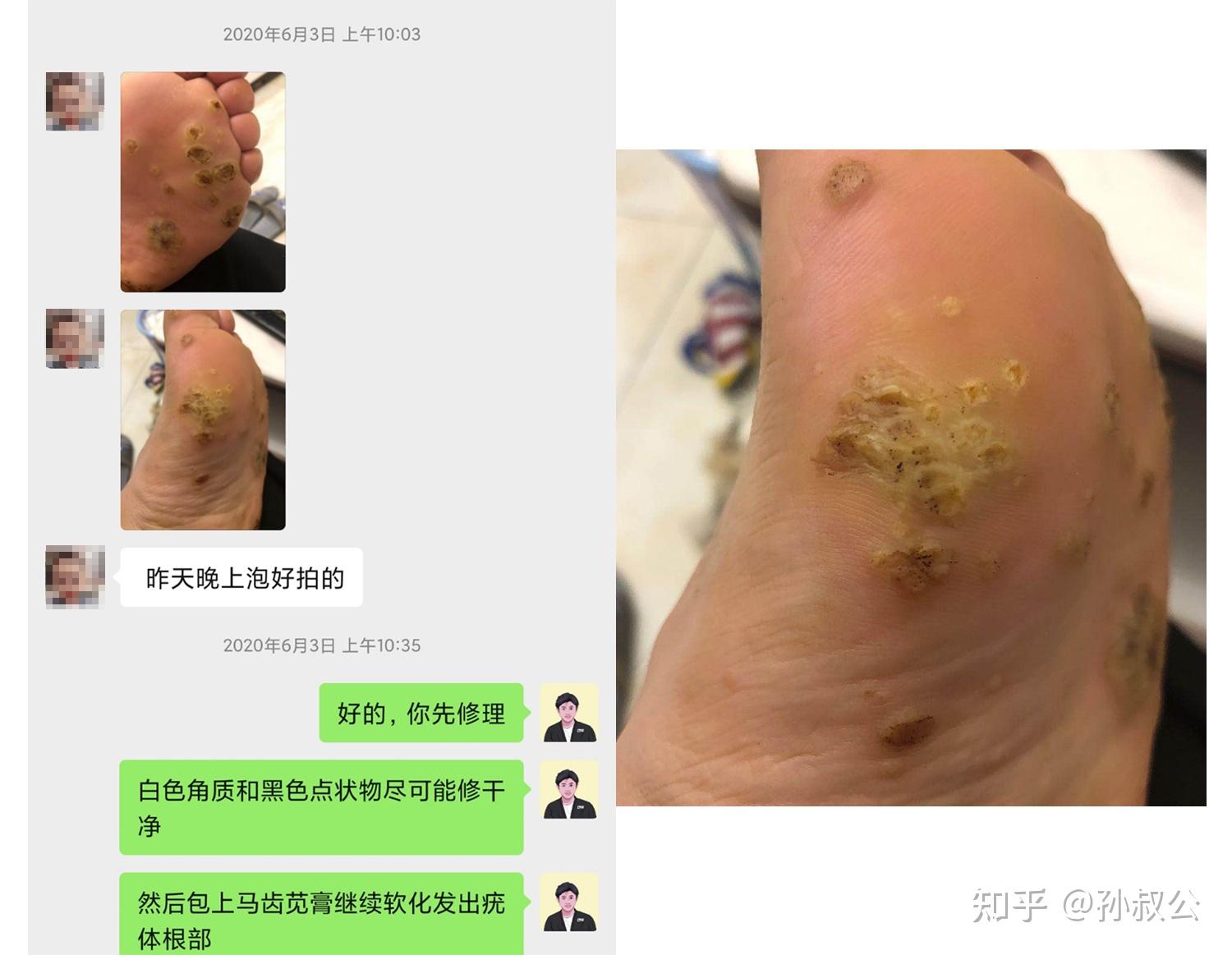 多颗跖疣20实例一招分清刺瘊鸡眼扁平疣详图版