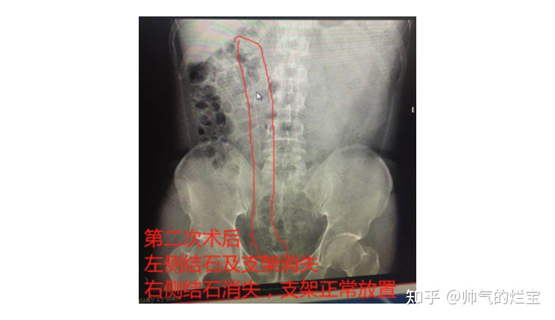 湖北男子雙側輸尿管結石梗阻致雙腎積水專家危及腎功能