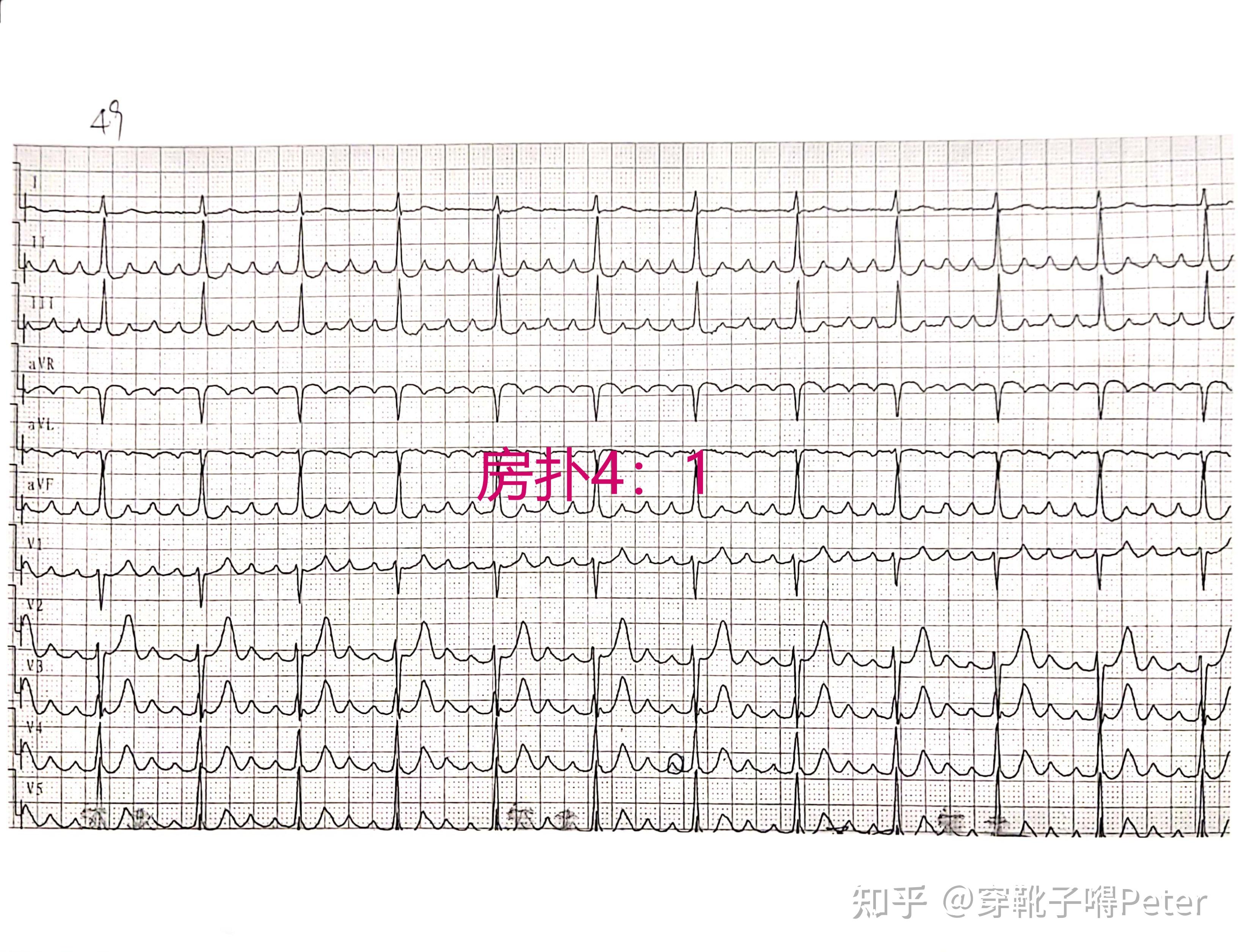 室上性心律心电图特征图片