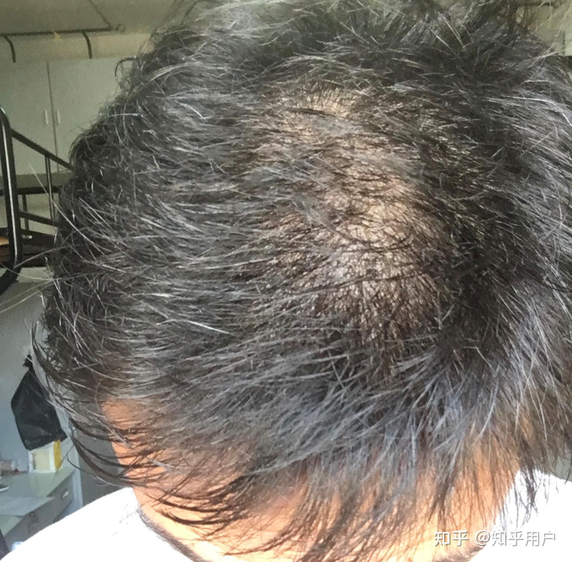 一个二十多岁男孩的脱发治疗之路