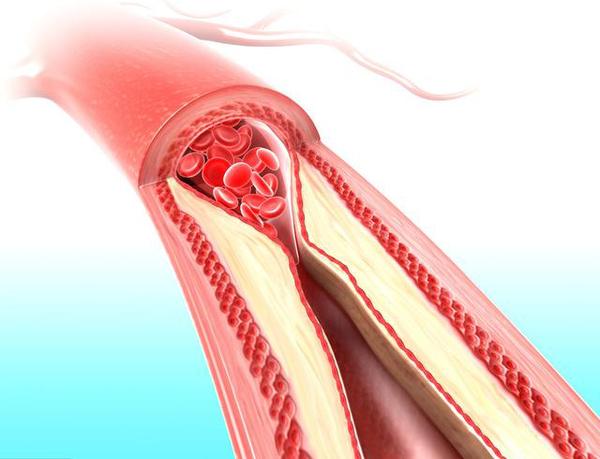 清理血管垃圾,防止斑块加重最好的2个办法,医生一次告诉您!