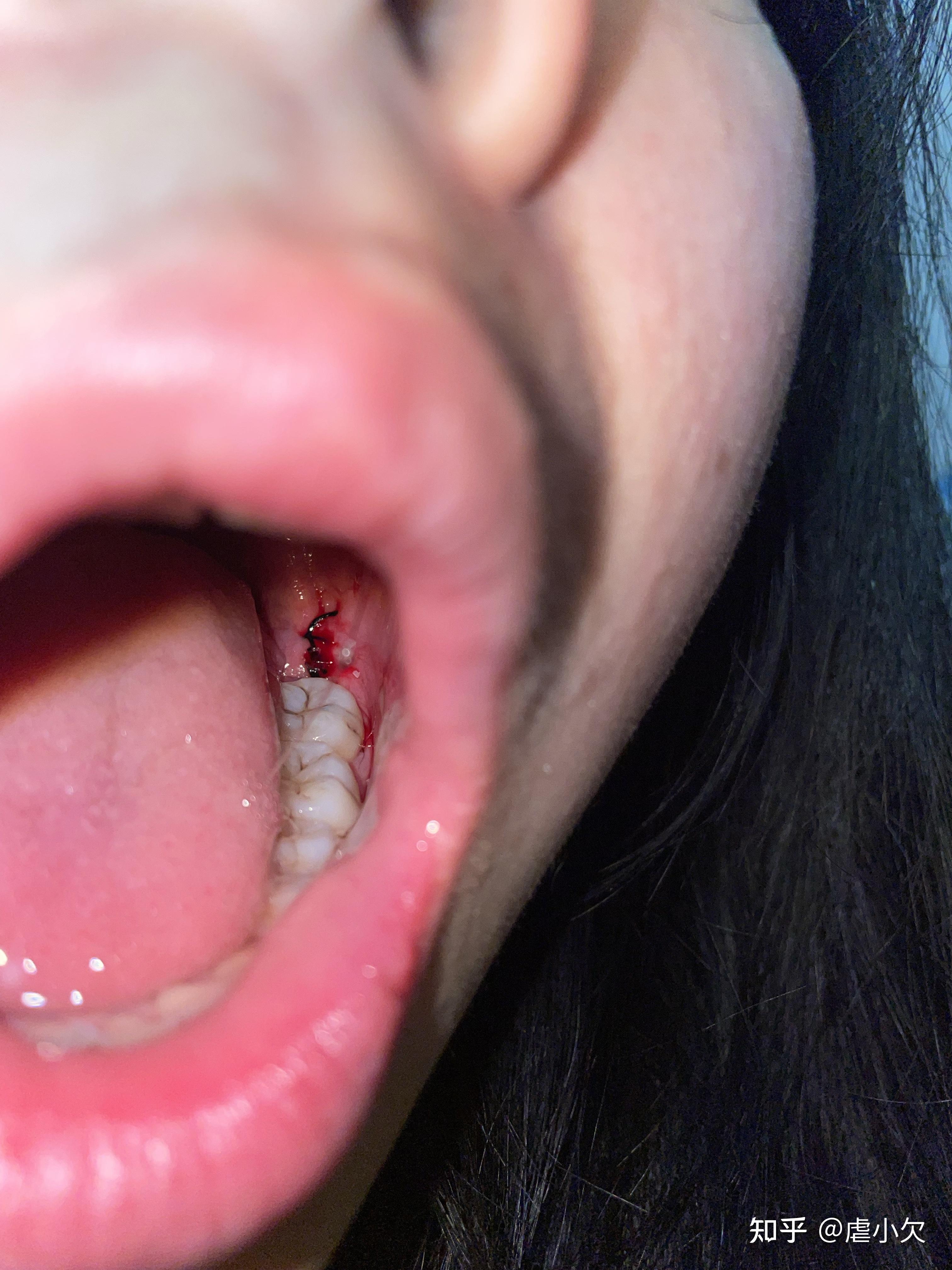 拔阻生智齿有多难受