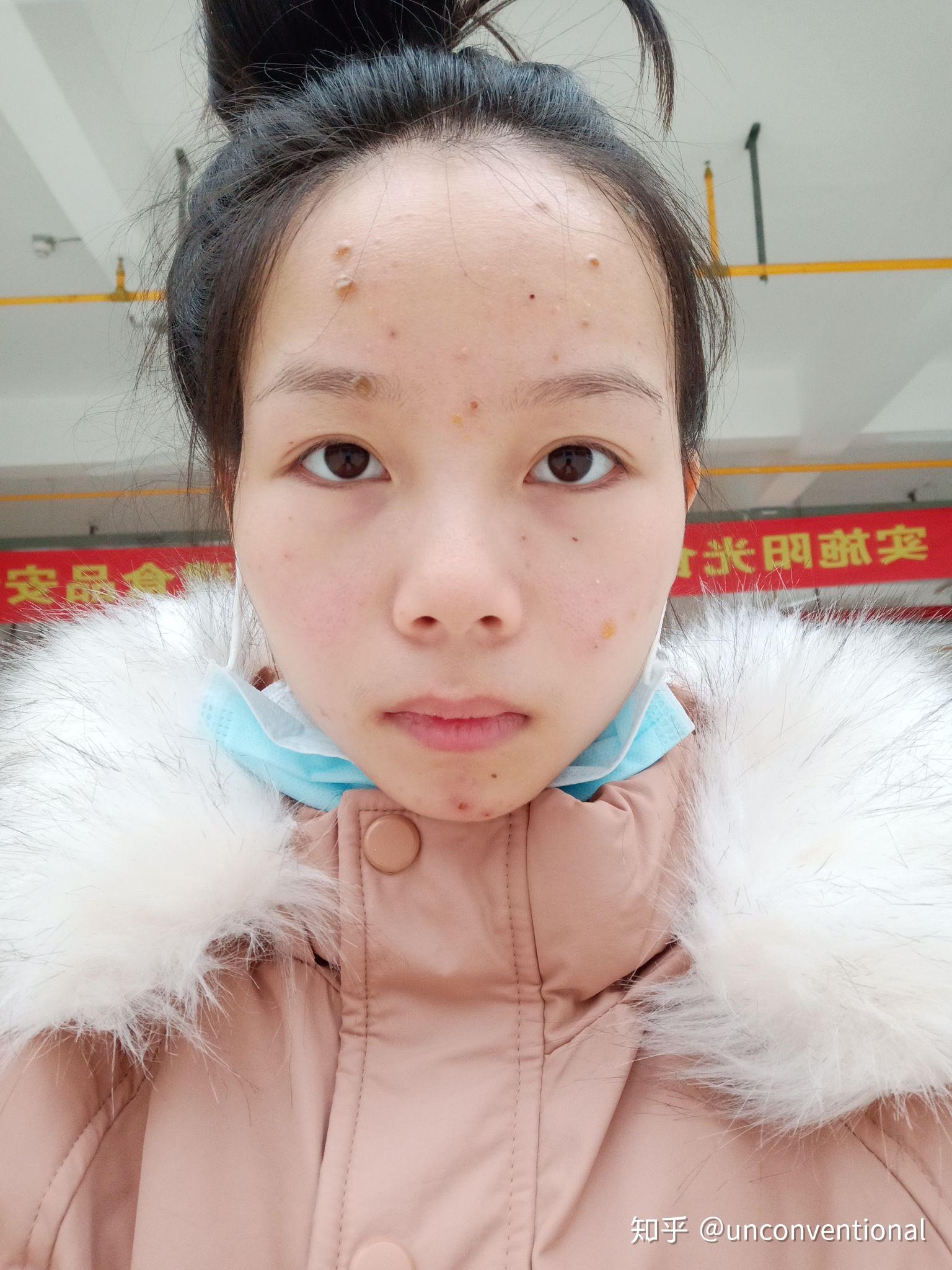 突然得水痘的感想体会