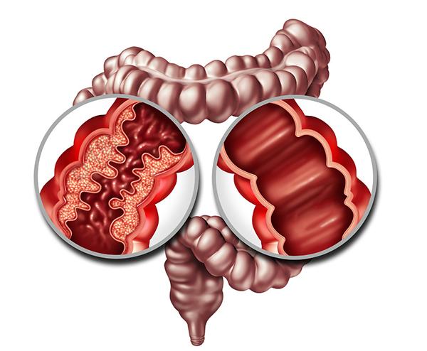 結腸黑變病是一種結腸黏膜脂褐色素沉著的非炎症疾病,雖然是一種良性