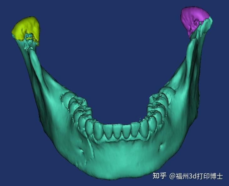 福建3d打印技術助力精準醫療 - 知乎