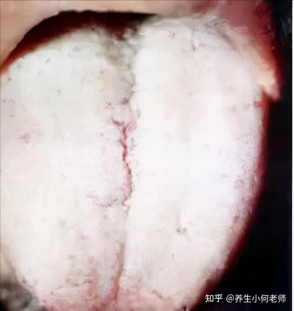 舌诊超级干货：图解舌诊！（每一个都配图） - 知乎