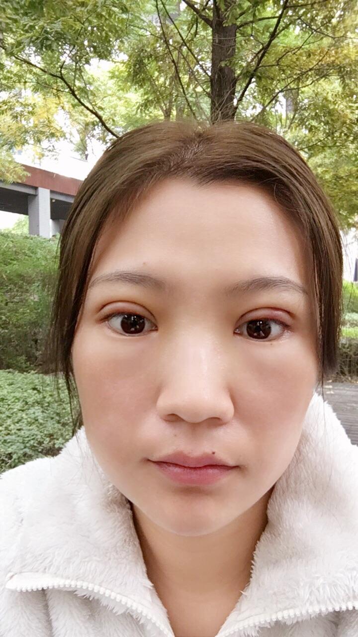 韩式全切双眼皮上睑下垂矫正手术恢复日记