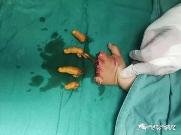 1岁半宝宝25指离断再植手术成功