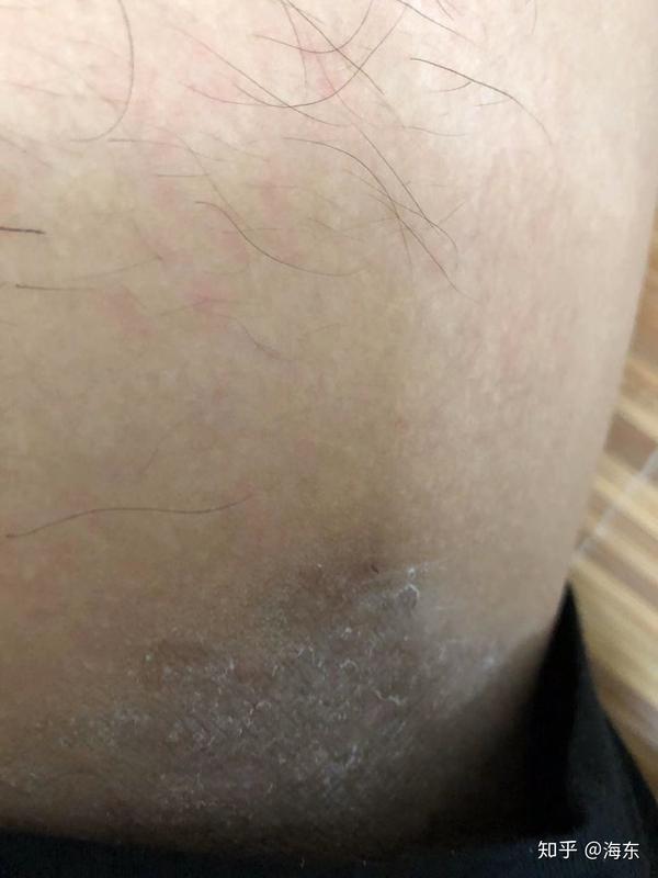 大腿内侧瘙痒是股癣还是湿疹该如何护理呢 知乎