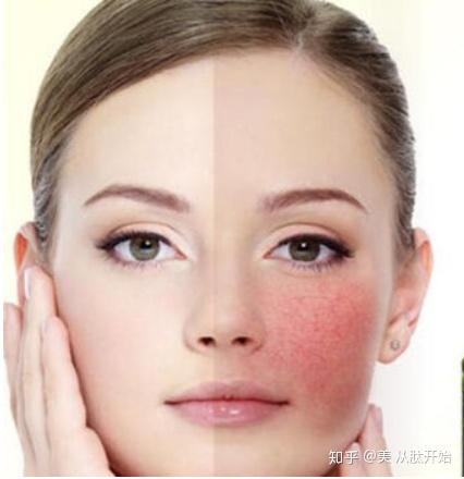皮肤敏感的原因 - 知乎