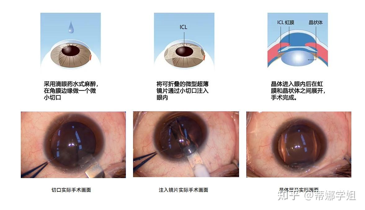 icl晶体植入术_icl晶体植入术是什么意思 icl晶体植入术_icl晶体植入术是什么意思（icl晶体植入术原理） 谷歌词库